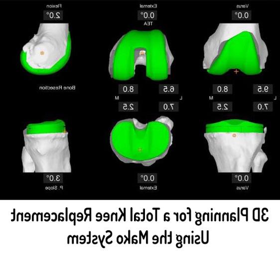 全膝关节置换术3D规划